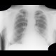 Lung congestion, first degree: X-ray - Plain radiograph